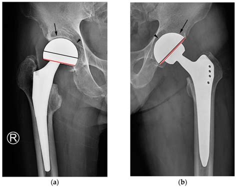 hip hemiarthroplasty orthobullets|Hip hemiarthroplasty .